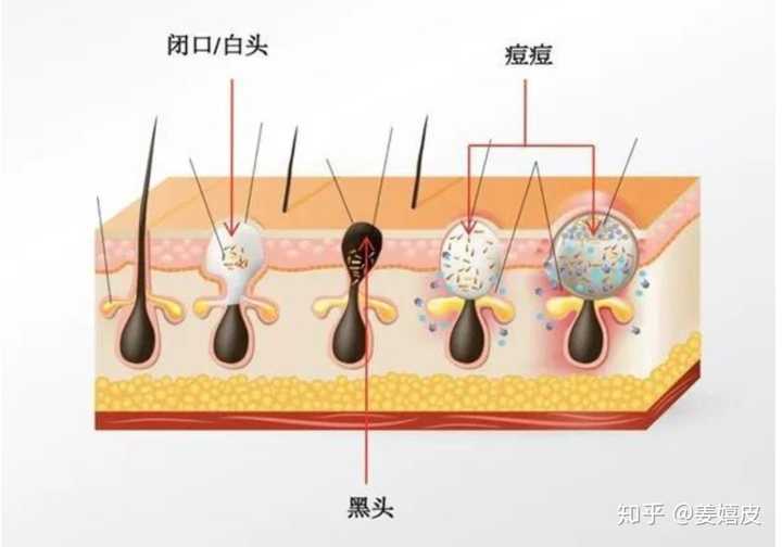 闭口怎么形成的?怎么去?