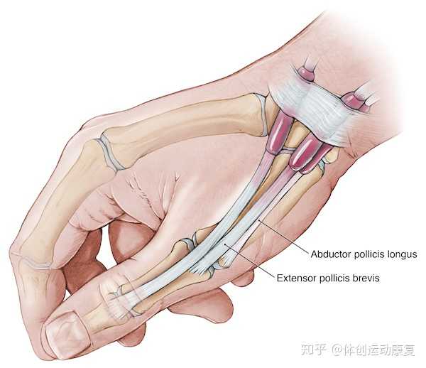 腱鞘炎可以根治吗?