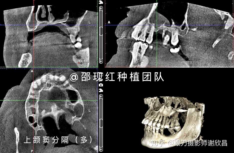 上颌窦腔,是4组鼻窦中的其中一组,处在上颌体内大约中心的位置