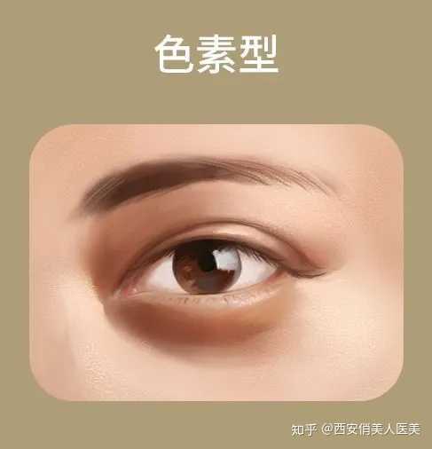 黑眼圈超级重怎么办啊,眼袋和泪沟也很重,怎么办?