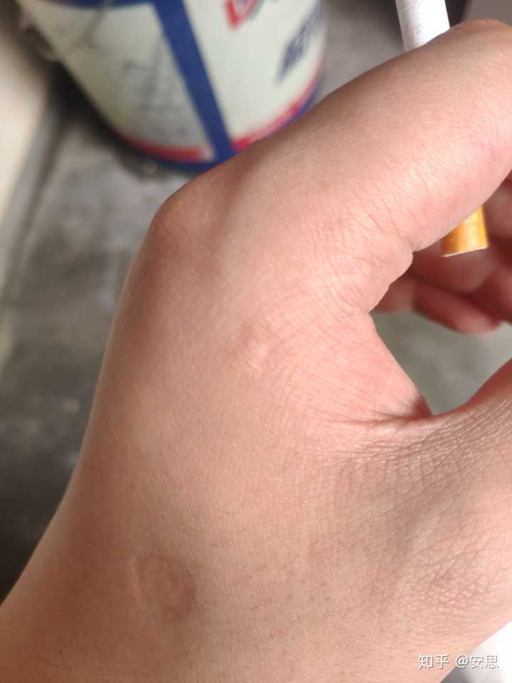 帮忙分析下,如果女朋友被人不注意烟头烫伤,男朋友应该怎么办?