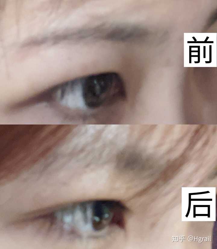 对于肉眼泡来说,做眼部抽脂安全么?
