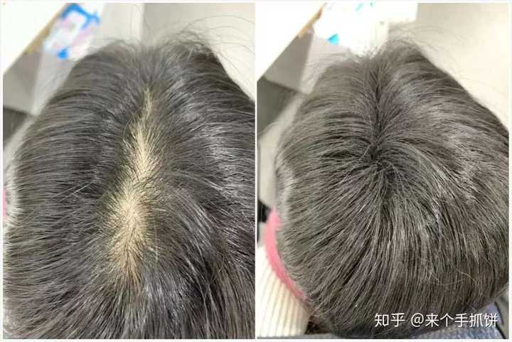 脱发了,该怎么办?