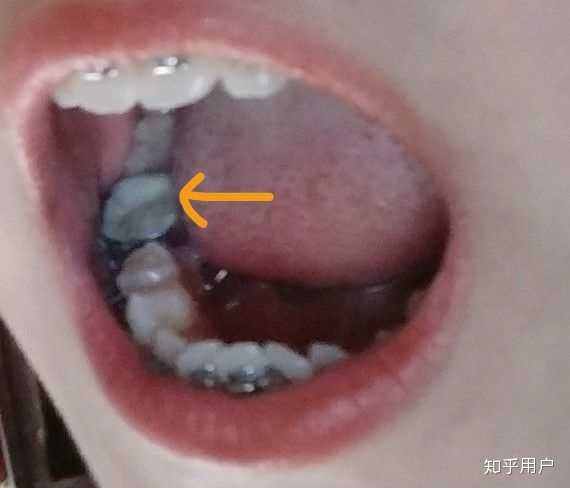 这是我根管治疗的那颗牙齿