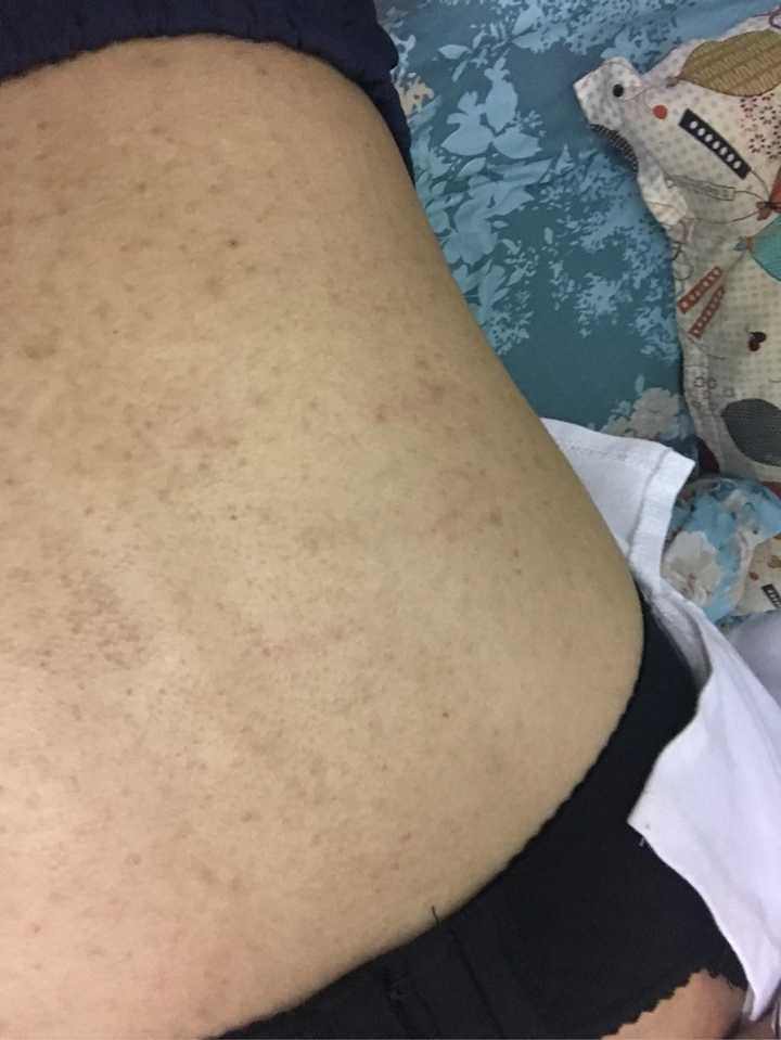 女生后背长痘痘有痘印怎么回事 怎么办?