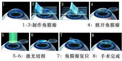 做激光近视手术的医生戴个眼镜,他自己为什么不做?