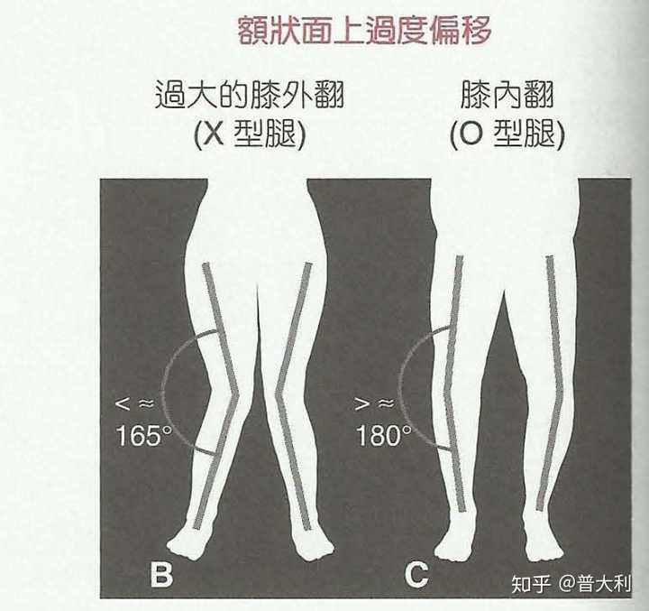 是指膝关节侧边的夹角大于180度,表现为两腿并拢时,膝关节不能够靠拢.