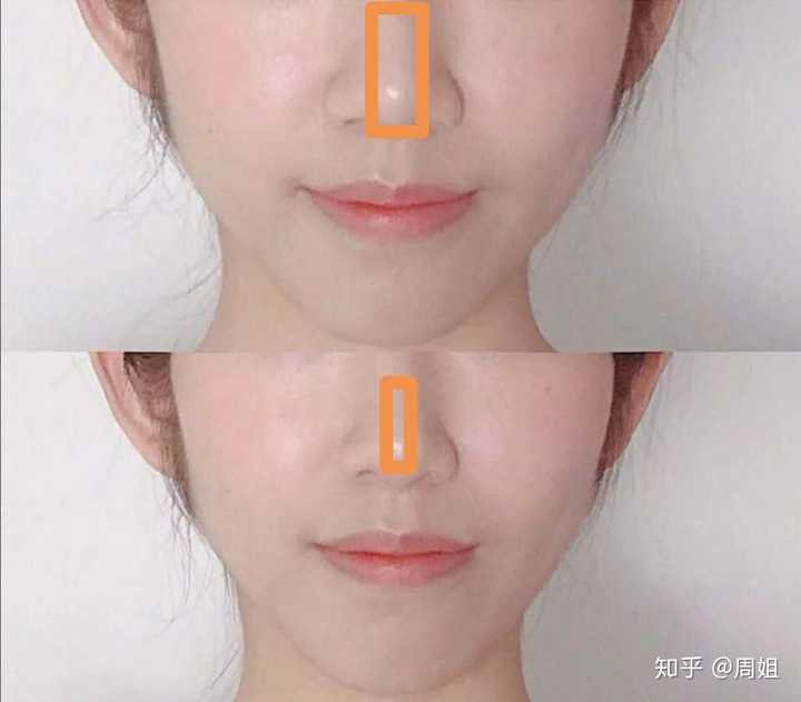 做过缩鼻头鼻翼的小仙女有什么感受吗?