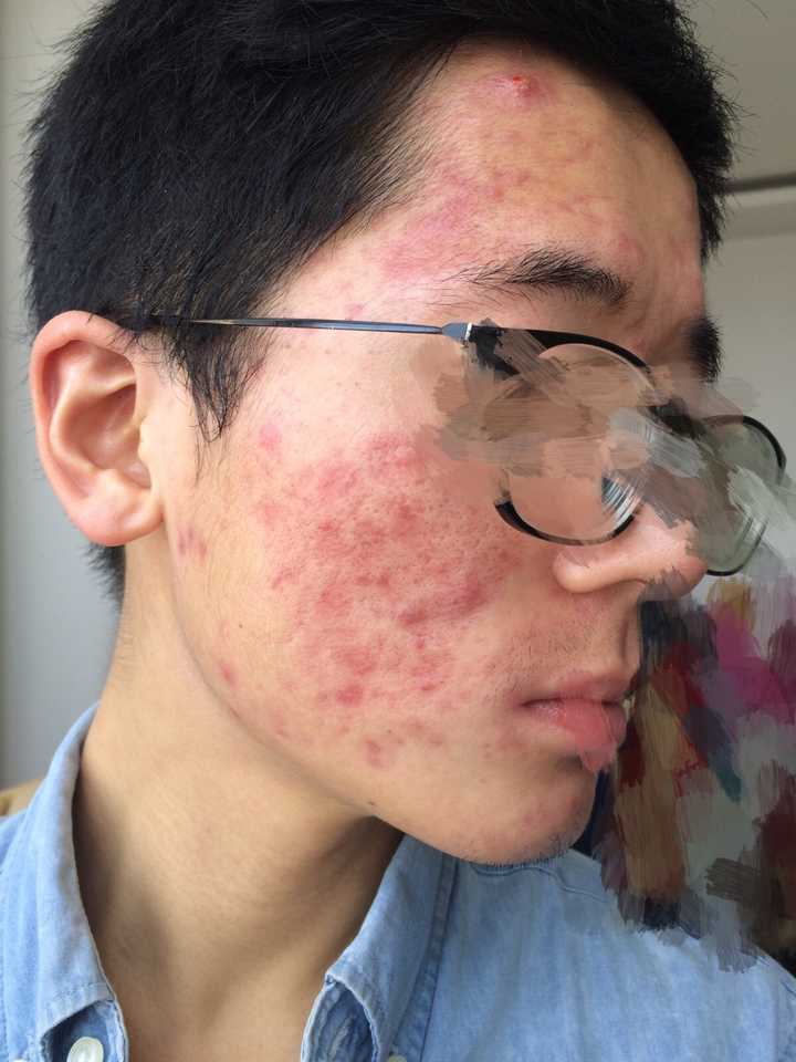 再然后去找三石医生检验过面部 结果发现我脸上有大量螨虫,溢脂性皮炎