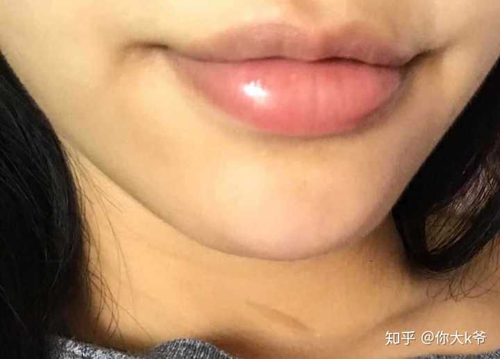 唇部状态常年不稳定,天气乾燥还会肿,边边发红,肿起来的时候还会外翻