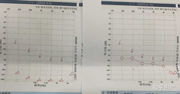 突发性耳聋治愈的可能性大吗