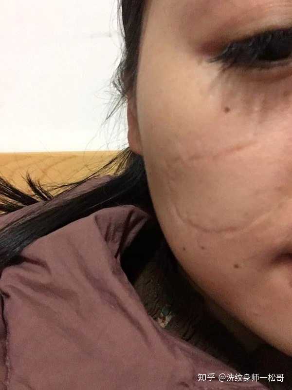 小时候打架脸上被抓了很多疤痕,可以怎么修复疤痕?