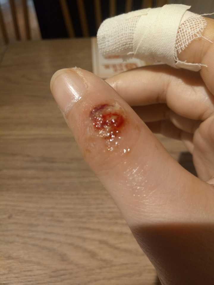 治疗手指上的寻常疣(鱼鳞痣)有什么办法,或者药物?