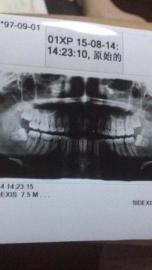 前几天突然很神奇的左下智齿开始疼,疼了第二天去口腔医院看医生