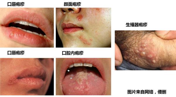 一生的陪伴——单纯疱疹病毒