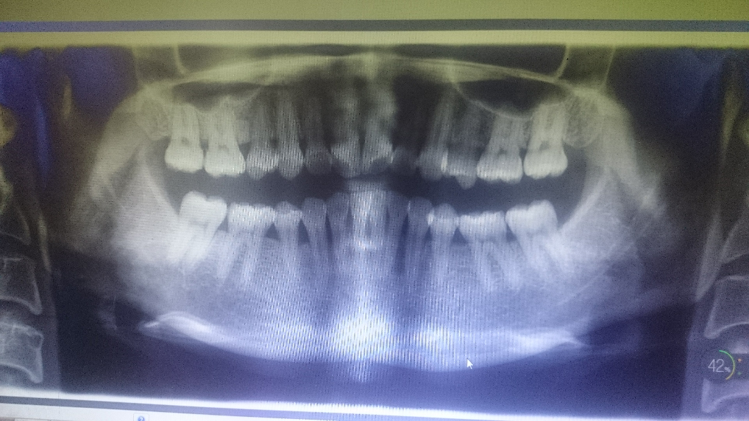 正畸25岁二次矫正十二岁做过大学长智齿复发