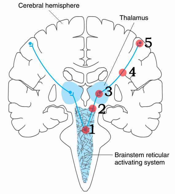 网状激活系统,让我们维持在觉醒的状态,这个系统里不管是脑干,丘脑