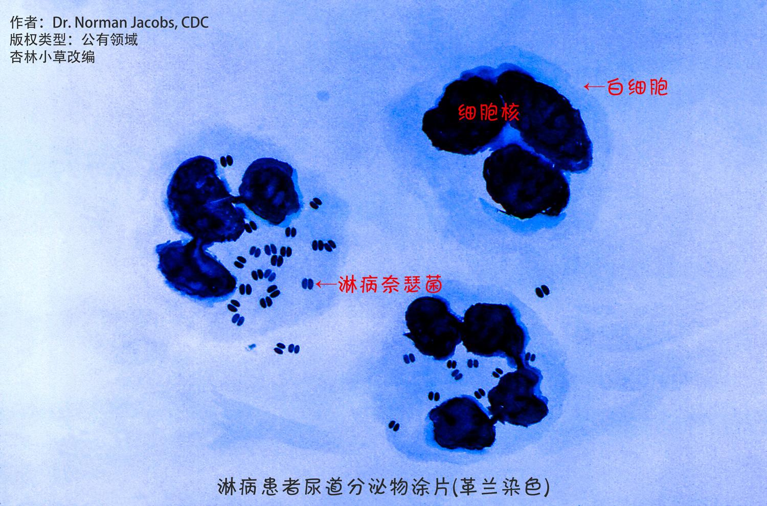 如图所示,淋病奈瑟菌是一种双球菌(成 双成对出现的 球形/椭球形细 菌