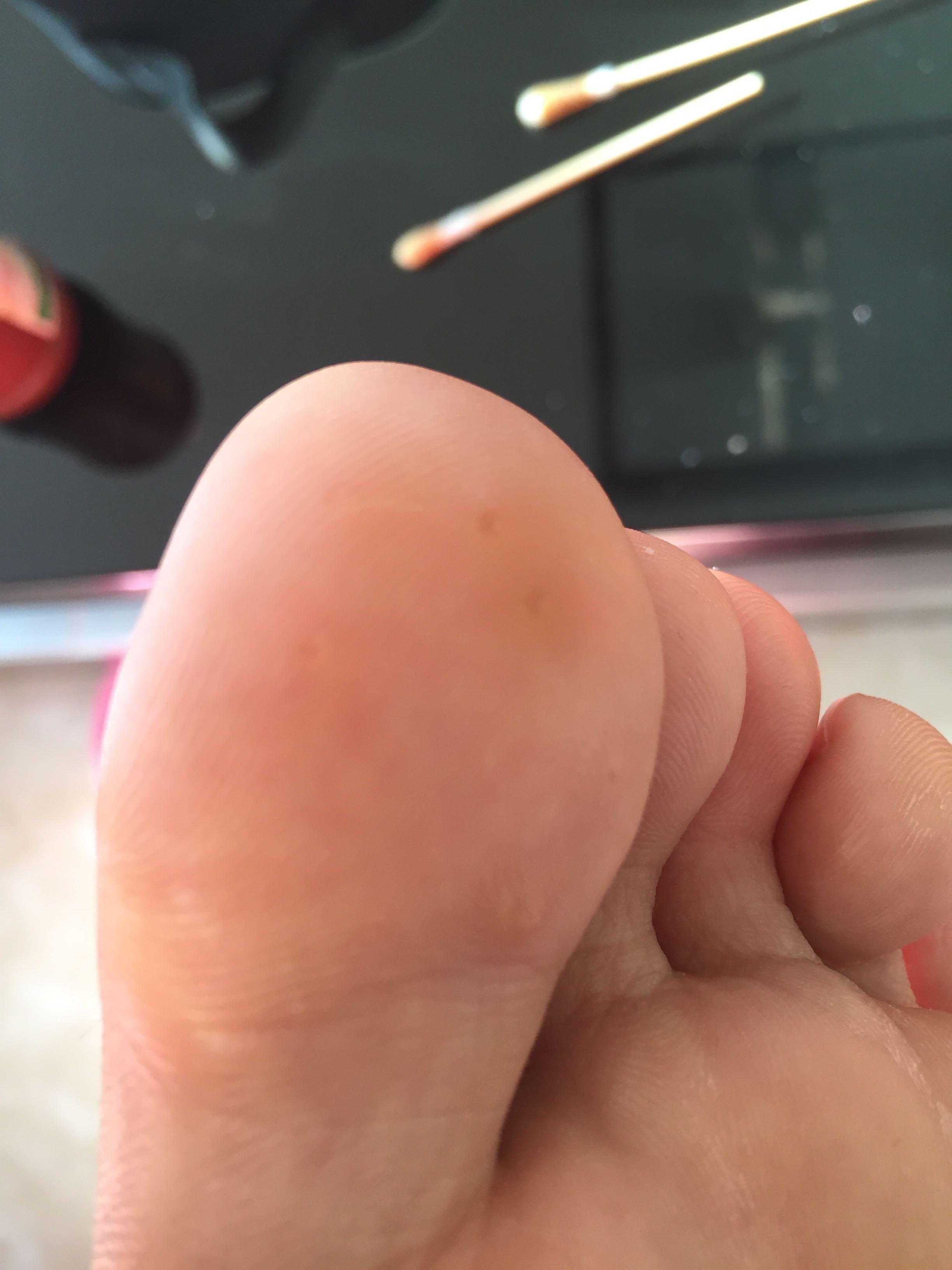 硬硬的,中间有点透明,一开始只有大脚趾有,后来发现脚底板也开始长,没
