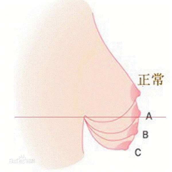 都说<em>文胸</em>穿的<em>不合适后果很严重</em>,有多严重啊?会