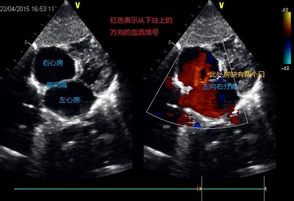 就是上面说的,腔静脉型,混合型和冠状静脉窦型不能做.此外还有筛孔型