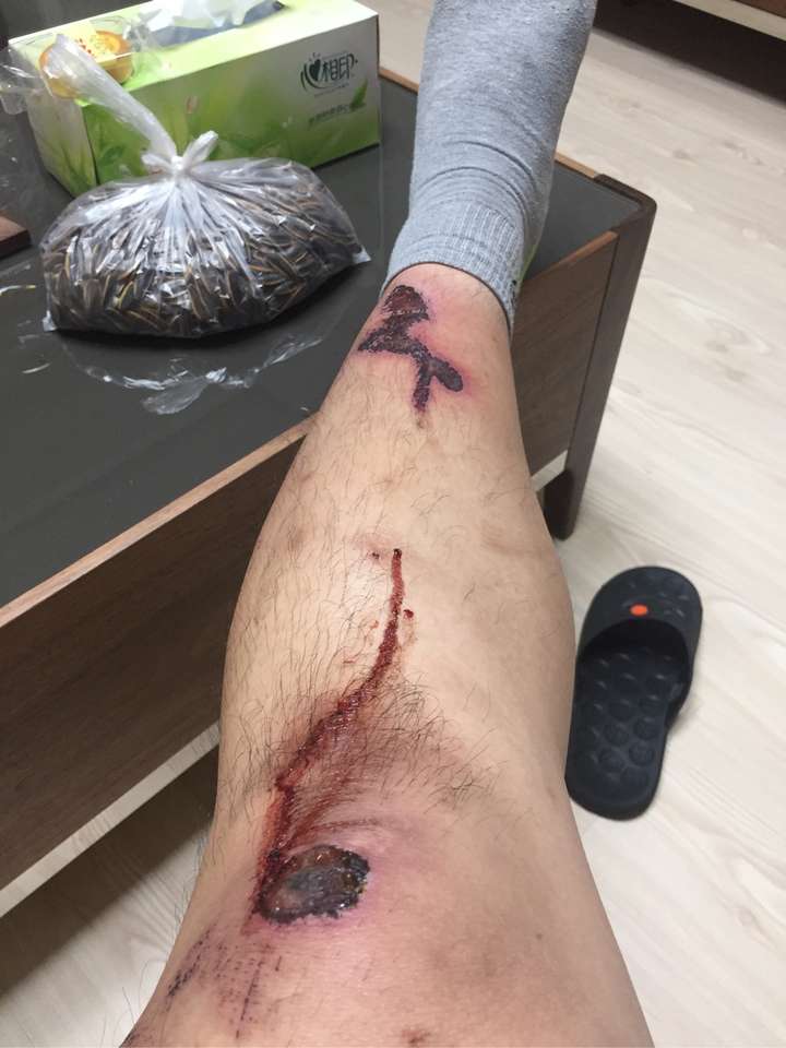 骑自行车摔了一跤现在夏天伤口结痂大概多久可以洗澡呢,今天已经第13