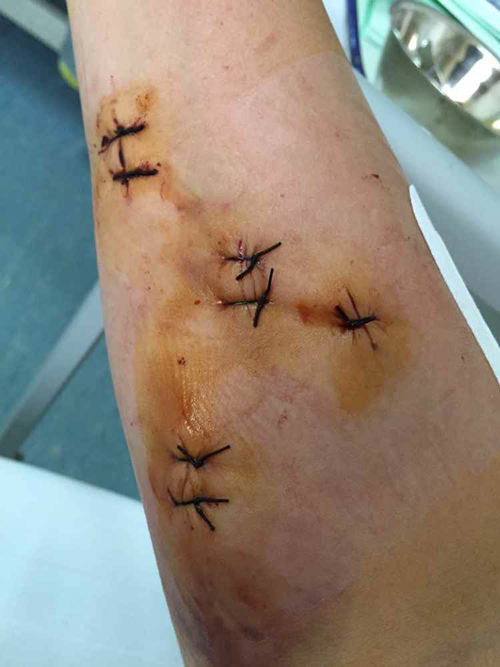 脂肪瘤成因?