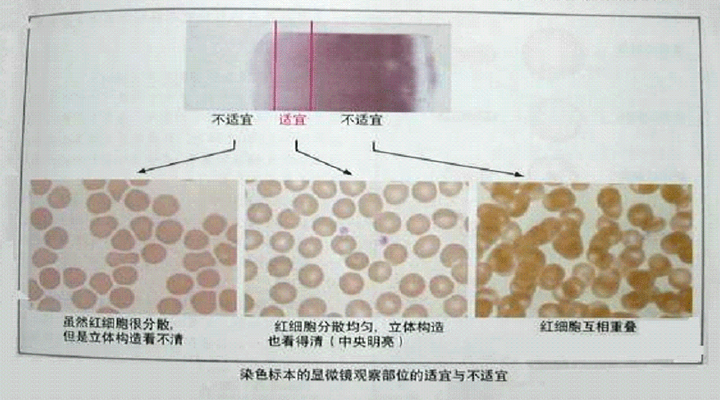 要是遇到胸腹水什么的,我眼睛好,冰醋酸 牛鲍计数板=天下无敌!