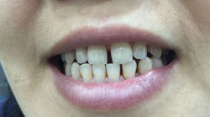 两颗门牙之间有缝拍照都不敢笑了如何修复有没有牙医帮助