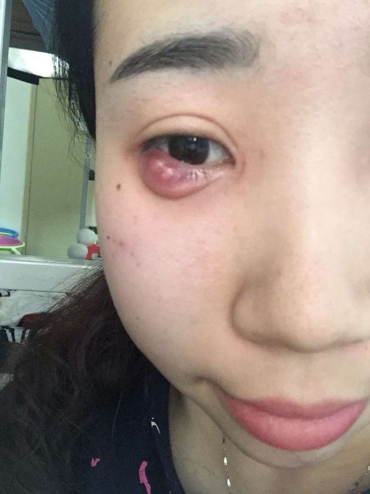 麦粒肿要多长时间好?