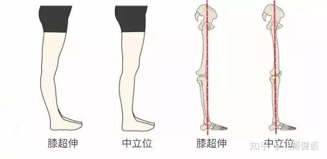 如果是膝关节超伸情况的o型腿,只需要改善膝关节超伸就行了,如果是