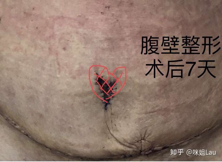 是不是必须做腹壁整形?