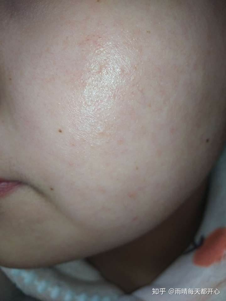 如果是敏感肌,脸上有轻微的红血丝,不能长期敷面膜的话怎么护肤?