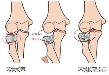 第二,环状韧带薄弱松弛,在桡骨头回归原位时环状韧带不及退缩第一