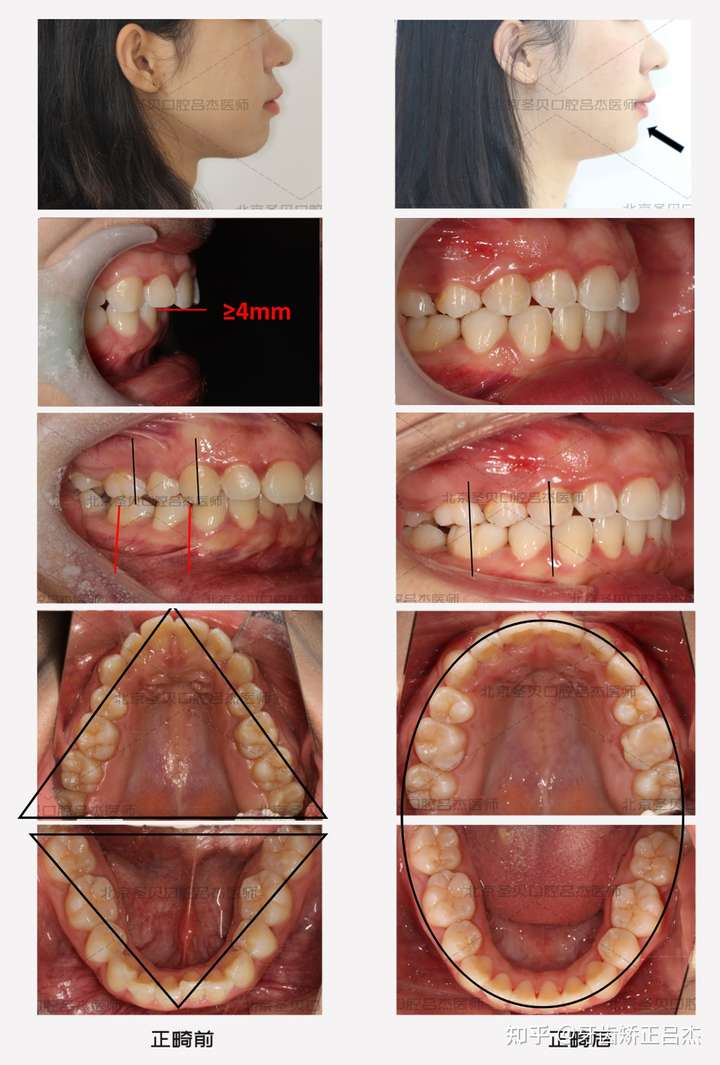 牙性前突成分居多时,仍然可以通过拔牙矫正改善嘴突(掩饰性正畸,骨性