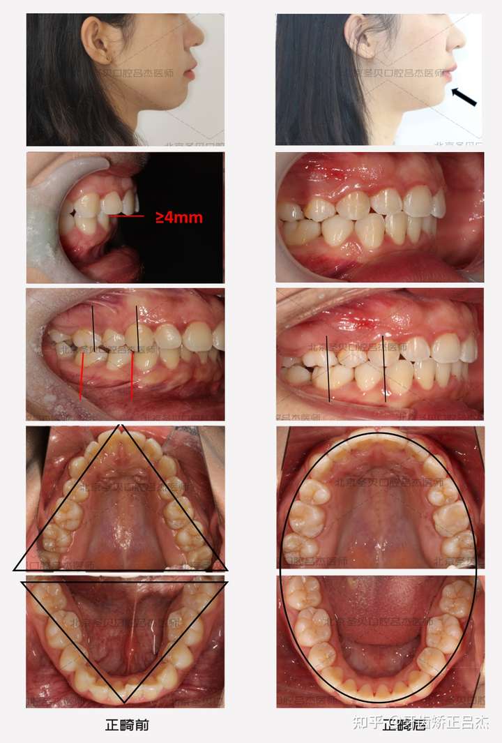 如果牙齿还算整齐,但就是嘴突,那么就要考虑是上/下颌前突了,其中,牙