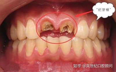 烂牙不拔会导致什么严重后果