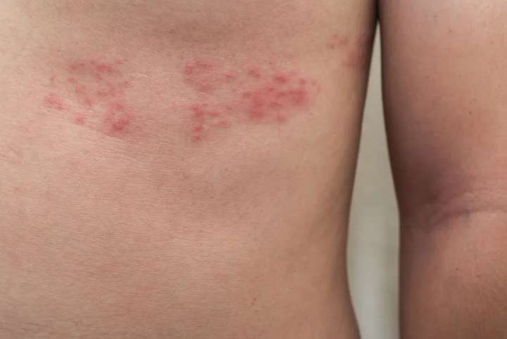 带状疱疹是潜伏在感觉神经节的水痘-带状疱疹病毒经再激活引起的皮肤