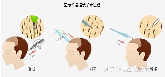 植发能用他人的毛囊吗?体毛可以吗?