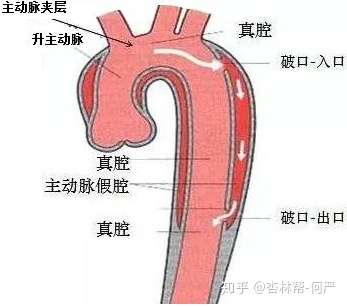 与时间赛跑,主动脉夹层动脉瘤腔内修复!