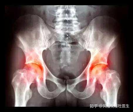 骶髂关节炎和强直性脊柱炎的区别有哪些?