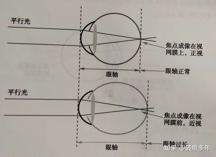 低龄儿童近视佩戴眼镜是否必要?有何注意点?