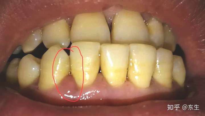 说明一下:我这颗牙齿也是新的切牙,不是乳牙