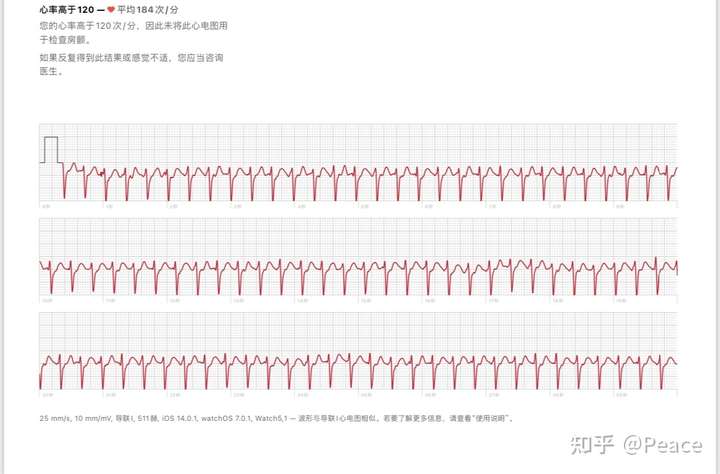 apple watch的ecg心电图真的没用么?