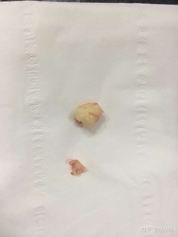这是我的牙齿,冲了一下,不然有血迹,好像还连着点肉