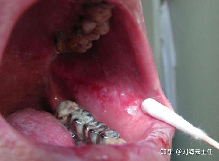 其实这是口腔白斑,口腔白斑病是发生于口腔黏膜以白色病损为主的损害