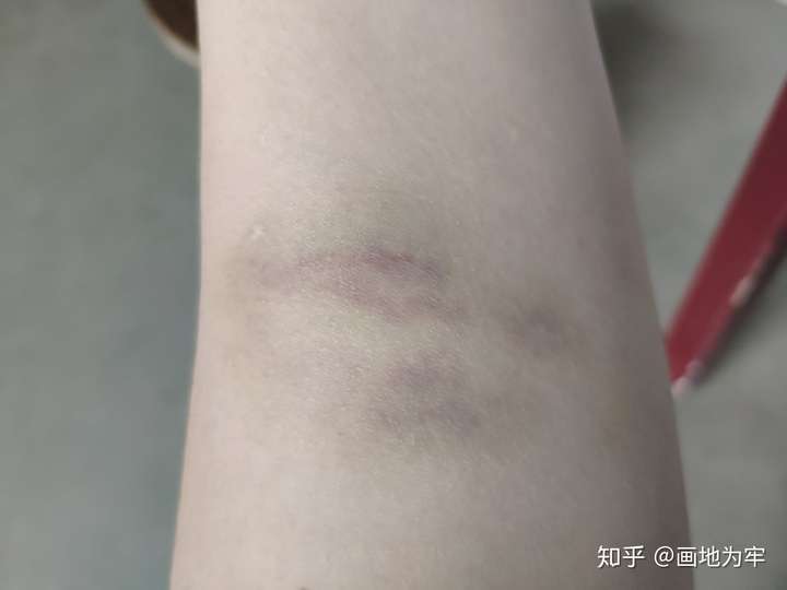 身上总会莫名其妙起淤青是什么原因?
