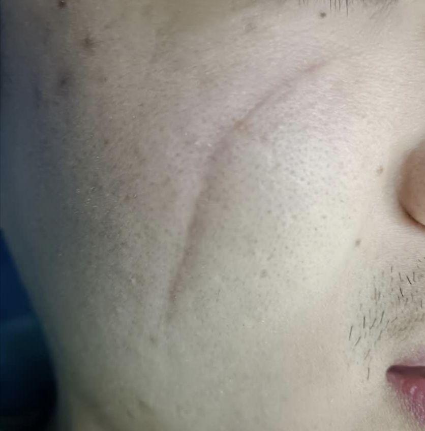 凹陷疤痕不做手术真的可以用药物修复吗?