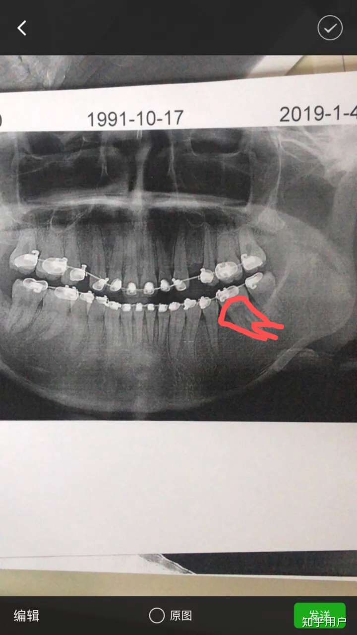 口腔下牙左6缺失是种牙好还是通过正畸把左7和智齿拉过来好?
