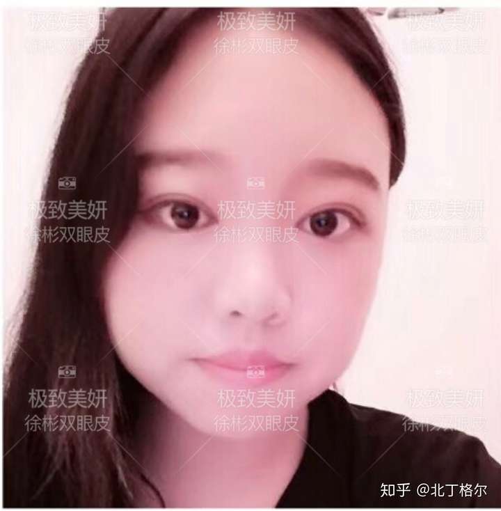 有肿眼泡和重度内眦赘皮轻度外眦赘皮以及中度提肌无力的内双能自然便